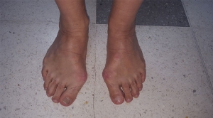 ortopedistas-pie-y-tobillo-hallux-valgus-01