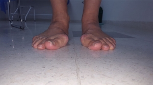 Ortopedistas Pie y Tobillo - Hallux Valgus