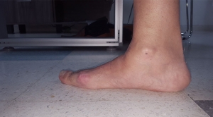 Ortopedistas Pie y Tobillo - Hallux Valgus