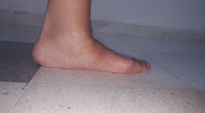 Ortopedistas Pie y Tobillo - Hallux Valgus