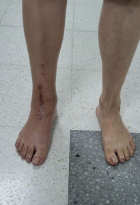 Ortopedistas Pie y Tobillo - Artrosis y artritis Pos-operatorio