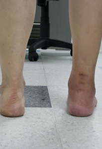 Ortopedistas Pie y Tobillo - Artrosis y artritis Pos-operatorio
