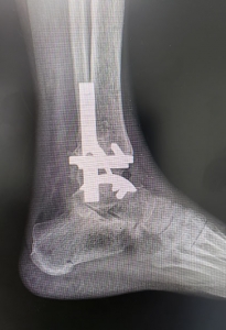 Ortopedistas Pie y Tobillo - Artrosis y artritis Radiografía Pos-operatoria