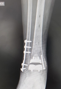 Ortopedistas Pie y Tobillo - Artrosis y artritis Radiografía Pos-operatoria