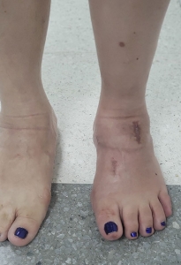 Ortopedistas Pie y Tobillo - Pie Cavo Post-operatorio tercer mes