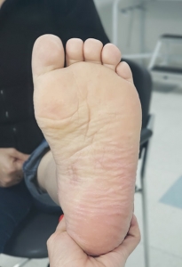 Ortopedistas Pie y Tobillo - Pie Cavo Post-operatorio tercer mes