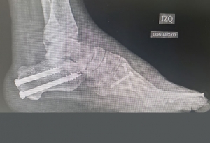 Ortopedistas Pie y Tobillo - Pie Cavo Radiografía Pos-operatoria tercer mes