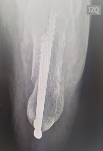 Ortopedistas Pie y Tobillo - Pie Cavo Radiografía Pos-operatoria tercer mes