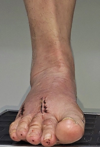Ortopedistas Pie y Tobillo - Artritis Clínica Post-operatorio