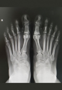 Ortopedista Pie y Tobillo  - Artroplastia RX