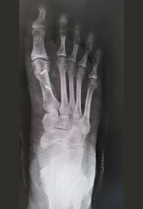 Ortopedista Pie y Tobillo  - Artroplastia RX