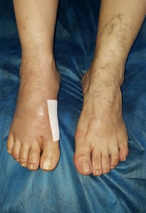 Ortopedistas Pie y Tobillo - Hallux Valgus Post-quirúrgico