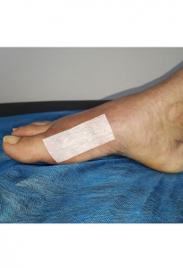 Ortopedistas Pie y Tobillo - Hallux Valgus Post-quirúrgico