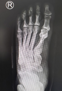 Ortopedistas Pie y Tobillo - Hallux Valgus Post-quirúrgico