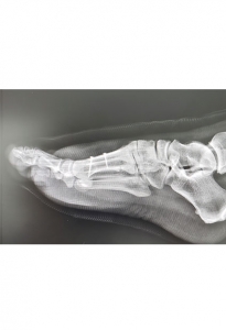 Ortopedistas Pie y Tobillo - Hallux Valgus Post-quirúrgico