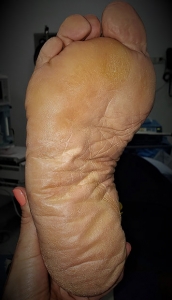 Ortopedista Pie y Tobillo  - Metatarsalgia